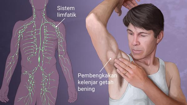 Bahaya Kanker Darah Limfoma Dan Leukimia